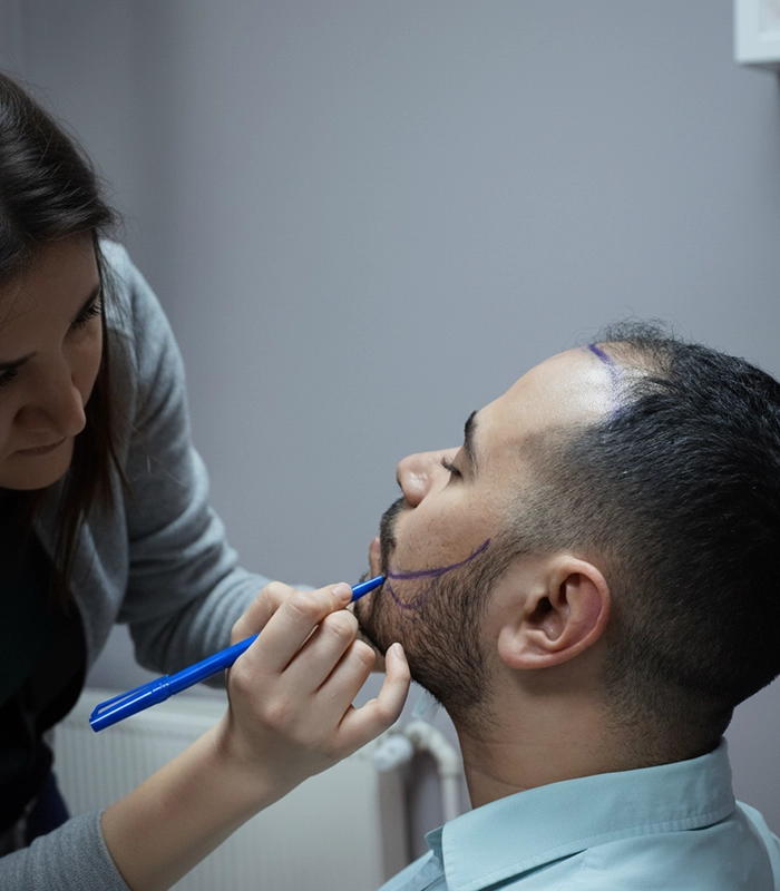 Beard Transplant