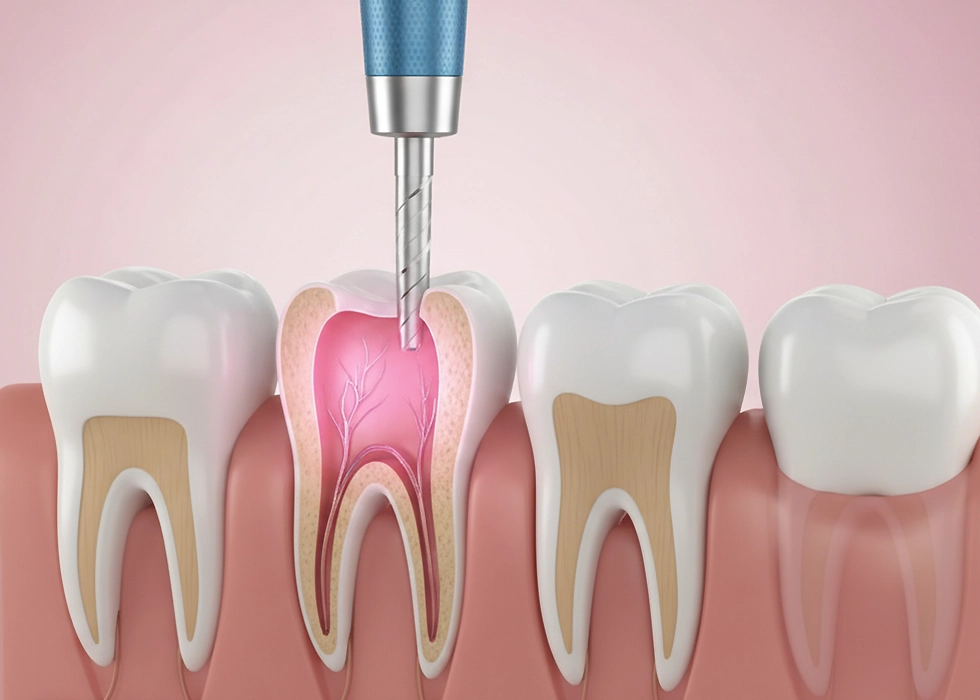 Advanced root canal treatment designed to remove infection and provide lasting pain relief and comfort