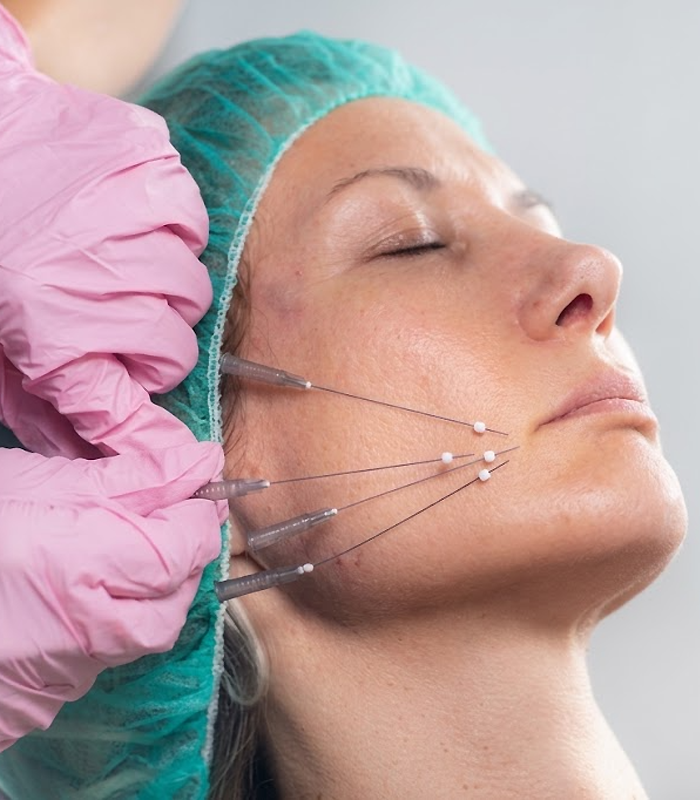 Thread lift treatment to tighten skin, improve elasticity, and give a firm youthful lifted appearance